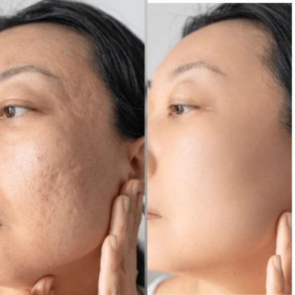 Scar Treatments treatment result